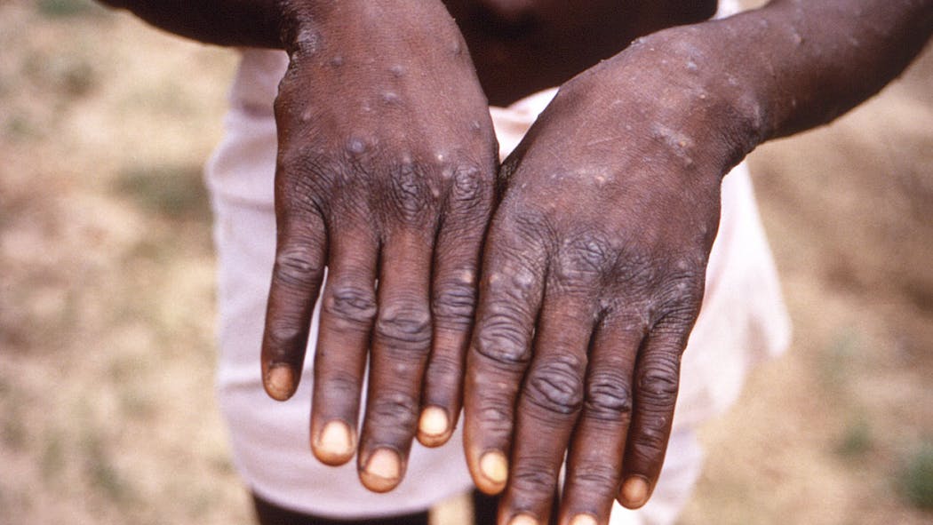 African Scientists Baffled By Monkeypox Cases In Europe, US-AP