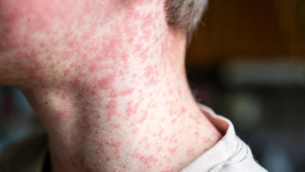 Measles symptoms